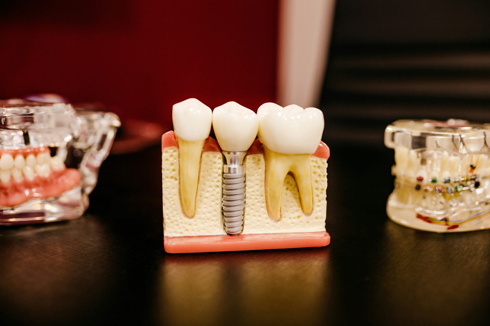 Sectioned dental implant model showing fixture, abutment and crown